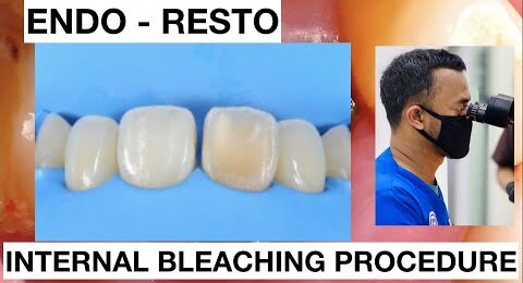 Internal-Bleaching-Teeth-Discoloration-1