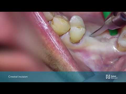 Maxillary-sinus-floor-elevation-with-simultaneous-implant-placement-with-GBR-1
