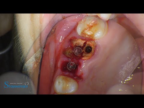 Peri-implant-tissue-management-IMPLA-Cylindrical-1