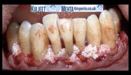 Periodontal-Surgery-Lower-Teeth-1
