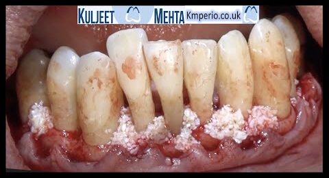 Periodontal-Surgery-Lower-Teeth-1