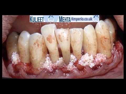 Periodontal-Surgery-Lower-Teeth-1