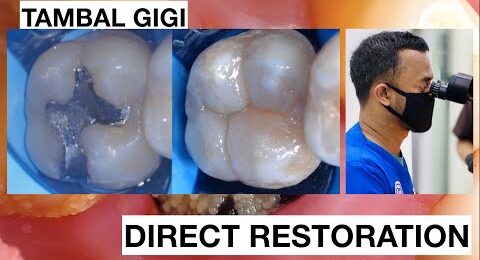Replacing-Amalgam-to-Natural-Composite-Bonding-Restoration