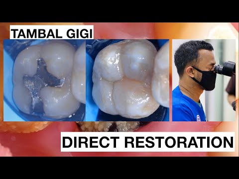 Replacing-Amalgam-to-Natural-Composite-Bonding-Restoration