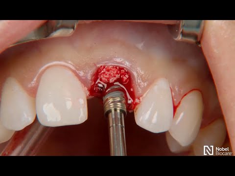 Restoration-of-a-central-incisor-1