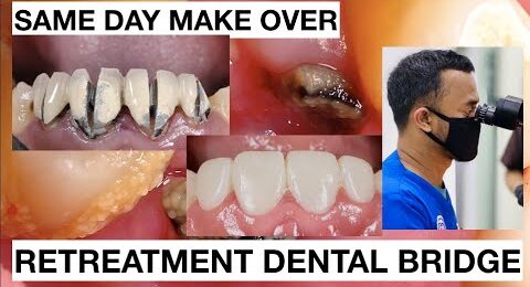 Same-Day-Smile-Make-Over-Retreatment-Dental-Bridge-1