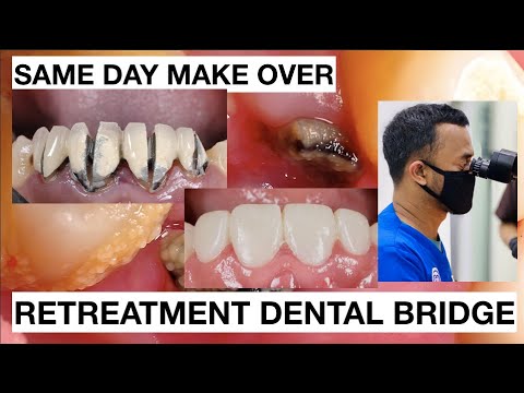 Same-Day-Smile-Make-Over-Retreatment-Dental-Bridge-1