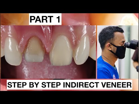 Step-by-Step-2-Indirect-Veneer-with-Discoloration2-2