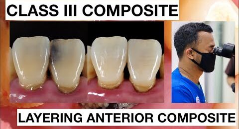 Step-by-Step-Class-III-Composite-Restoration-1