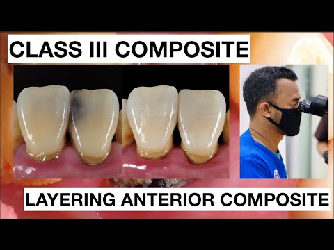 Step-by-Step-Class-III-Composite-Restoration-1