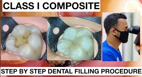 Step-by-Step-Dental-Filling-Procedure-1