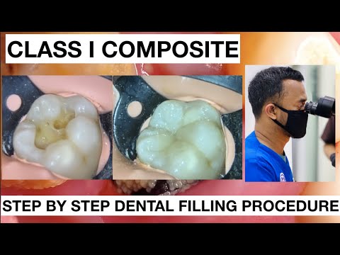 Step-by-Step-Dental-Filling-Procedure-1