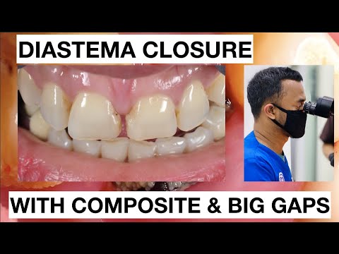 Step-by-Step-Diastema-Closure-Composite-with-Big-Gaps-1