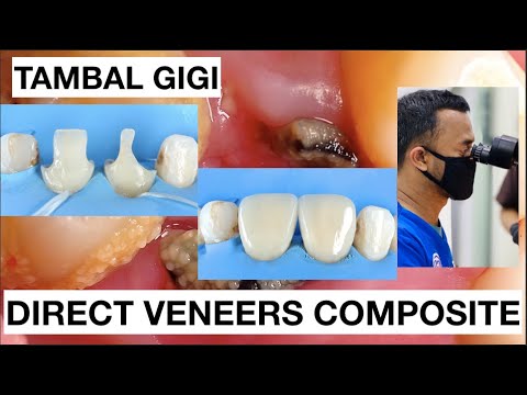 Step-by-Step-Direct-Veneer-Composite-Restoration-1