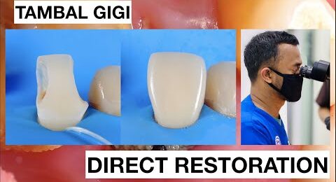 Step-by-Step-Direct-Veneer-Composite-Restoration-2