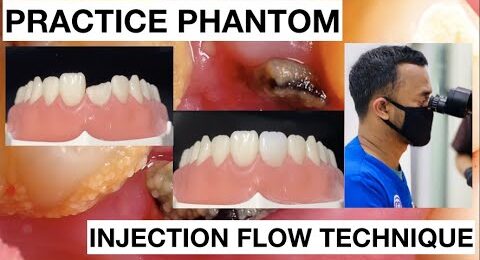 Step-by-Step-Injection-Flow-Anterior-Composite-1