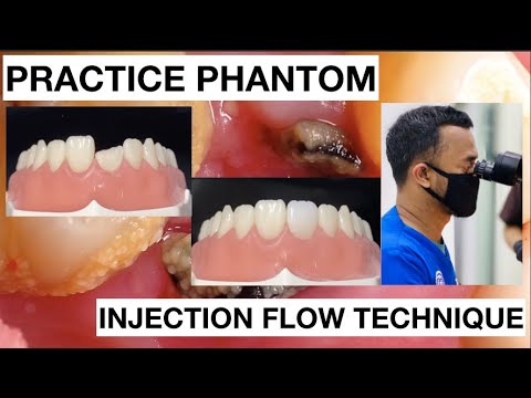Step-by-Step-Injection-Flow-Anterior-Composite-1