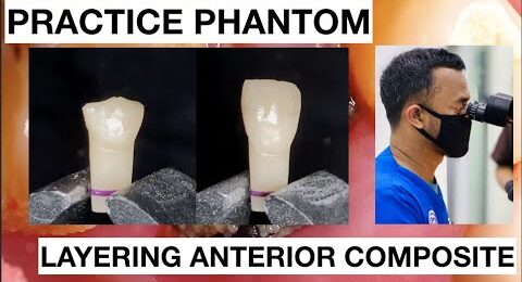 Step-by-Step-Layering-Anterior-Composite-1