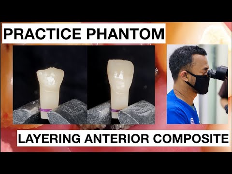Step-by-Step-Layering-Anterior-Composite-1