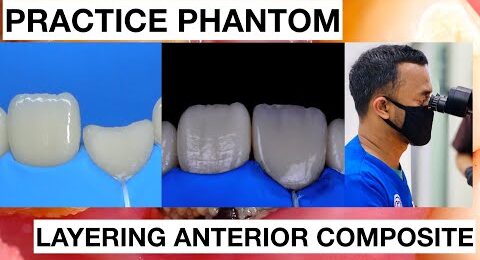 Step-by-Step-Layering-Anterior-Composite-2