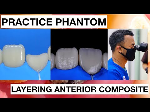 Step-by-Step-Layering-Anterior-Composite-2