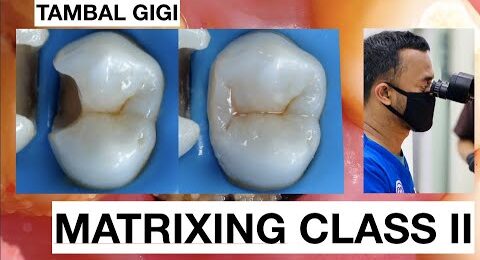Step-by-Step-Matrixing-Class-II-Premolar-1