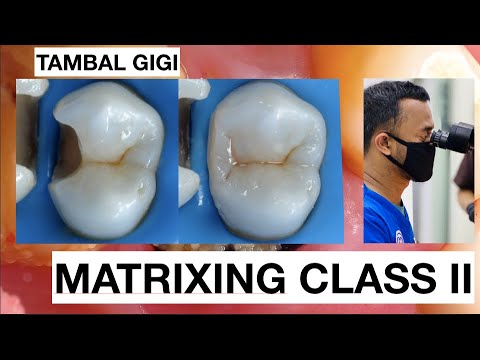 Step-by-Step-Matrixing-Class-II-Premolar-1