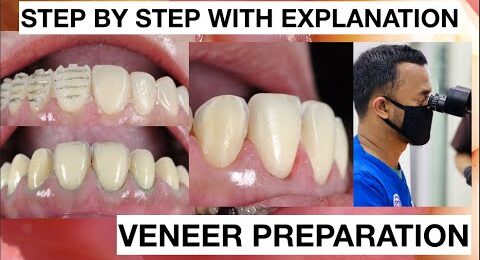 Step-by-Step-Minimally-Invasive-Veneers-Preparation