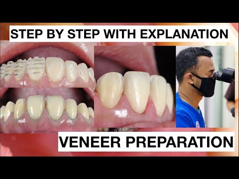 Step-by-Step-Minimally-Invasive-Veneers-Preparation