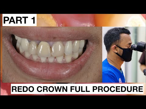 Step-by-Step-Redo-Dental-Crown-Part-1-1