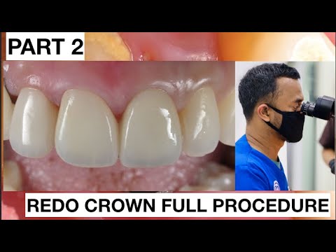 Step-by-Step-Redo-Dental-Crown-Part-2-1