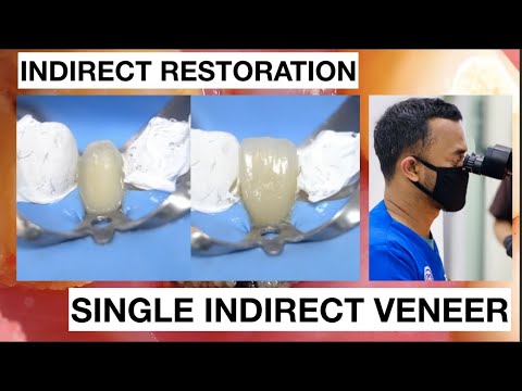 Step-by-Step-Single-Indirect-Veneer-Restoration-1