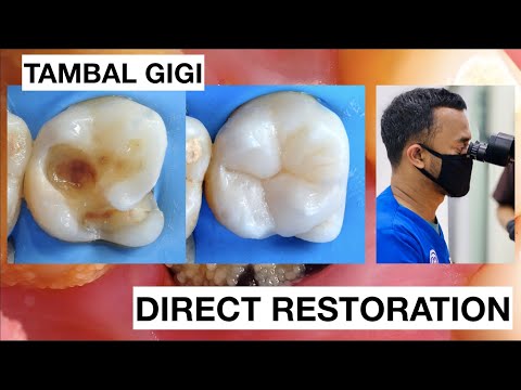 Step-by-step-Dental-Filling-Composite-Molar-Direct-Restoration-Dentist-Griya-RR