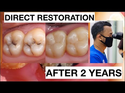 Step-by-step-Dental-Filling-Composite-Upper-Molar-Direct-Restoration-After-2-Years