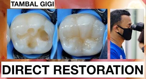 Step-by-step-Filling-Composite-Lower-Molar-Direct-Restoration-Class-1
