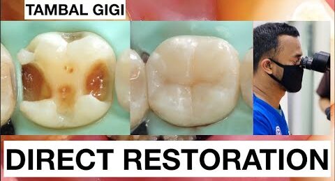Step-by-step-Filling-Composite-Lower-Molar-Direct-Restoration-Class-II-1