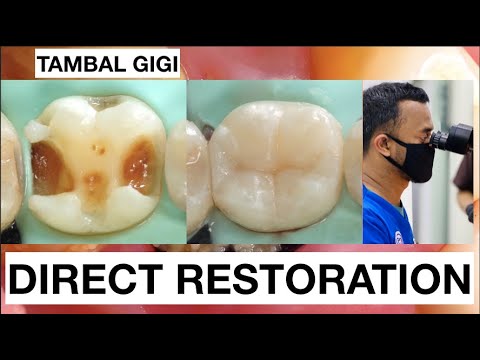 Step-by-step-Filling-Composite-Lower-Molar-Direct-Restoration-Class-II-1