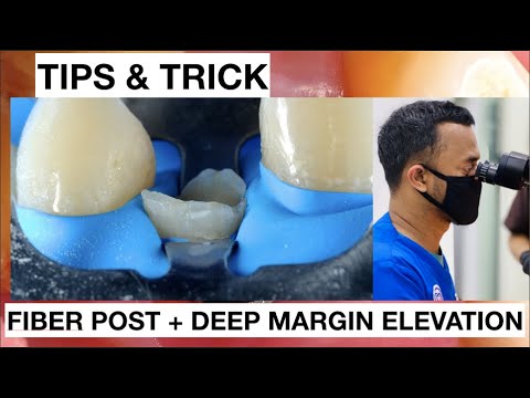 Tips-and-Trick-Fiber-Post-1