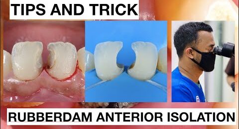 Tips-and-Trick-Rubberdam-Anterior-Isolation
