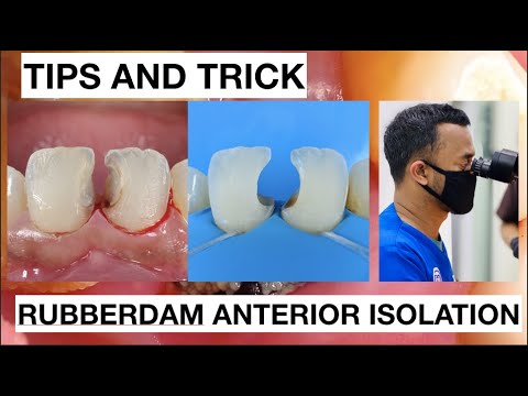 Tips-and-Trick-Rubberdam-Anterior-Isolation