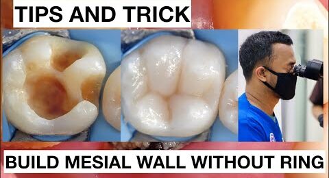 Tips-and-trick-How-To-Build-Mesial-Wall-Without-Ring-Clamp