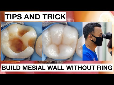 Tips-and-trick-How-To-Build-Mesial-Wall-Without-Ring-Clamp