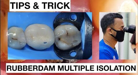 Tips-and-trick-How-To-Place-Rubberdam-On-Posterior-Lower-1
