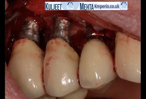 Treatment-of-Peri-implantitis-by-Implantoplasty.-1