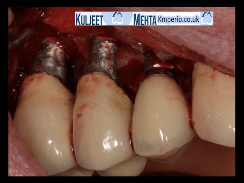 Treatment-of-Peri-implantitis-by-Implantoplasty.-1
