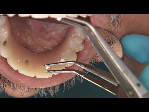 Why-Use-a-Provisional-for-Full-Arch-Implant-Cases-1